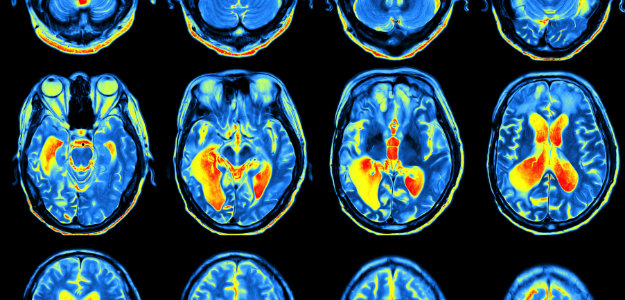 A brain scan of an individual with ADHD.